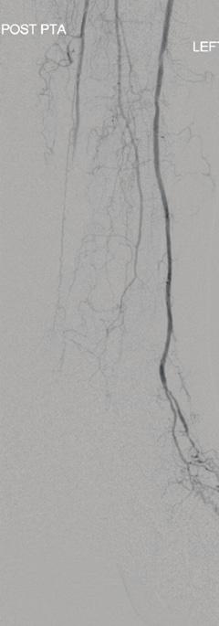 For this reason, aspiration thrombectomy is usually the first treatment approach. Figure 7. An iatrogenic tibial artery occlusion in an 86-yearold woman with a plantar ulcer.