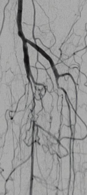 Complete posterior tibial artery occlusion that was unable to be revascularized (C).