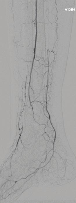 The posterior tibial artery was the wound-related artery.