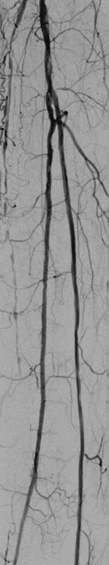 15,16 Ancillary techniques such as double-balloon angioplasty (retrograde and antegrade