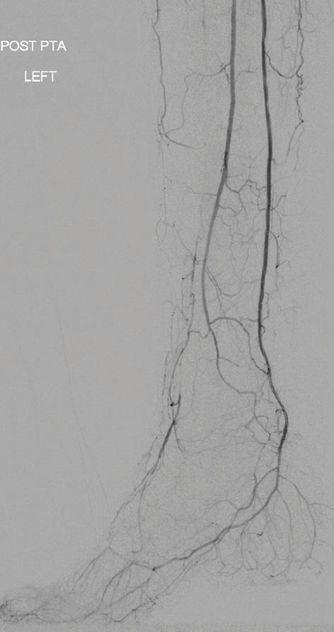 Most reentry devices are too bulky for use in the tibial arteries, although several