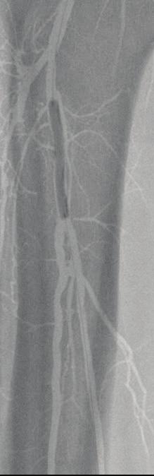 Tibial artery dissection is initially managed with prolonged, low-pressure balloon