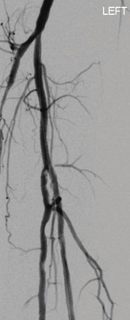 If there is a persistent dissection of hemodynamic significance, the use of a stent is