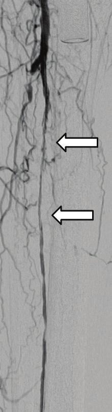 A B C Figure 10. Long residual stenosis and dissection following prolonged balloon angioplasty managed with a nitinol selfexpanding stent.