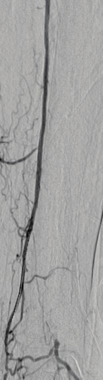 17 Arterial perforation during tibial artery intervention is an uncommon but potentially serious complication. Perforation was reported at an incidence of 5% in the BASIL trial.