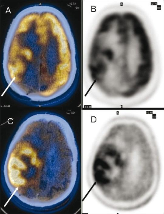 Glioma F DOPA is a radiolabelled amino acid and shows similar behaviour to 11 C Methionine Clinical Applications at Diagnosis Determining degree of malignancy Assessing prognosis Guidance for biopsy