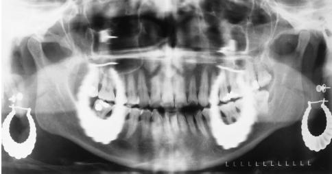Large Hoop Earrings and Ghost Images From Langlais RP, Miller CS: Exercises in oral radiology and