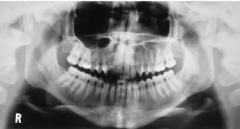 Exaggerated Smile Line From Langlais RP, Miller CS: Exercises in oral radiology and