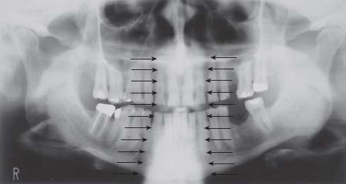 Superimposition of Cervical Spine From Langlais RP, Miller CS: Exercises in oral radiology and