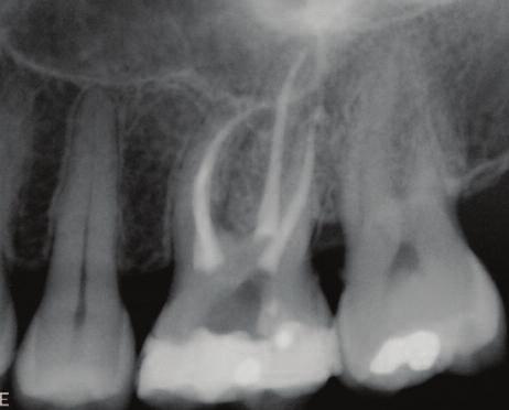 Clinical The influence of sensor size and orientation on image quality in intra-oral periapical radiography Tony Druttman 1 The periapical view is one of the standard intra-oral radiographs by which