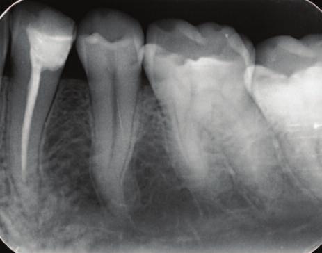 Clinical Figure 2: Effects of beam angulation and lesion size on appearance in radiographs.