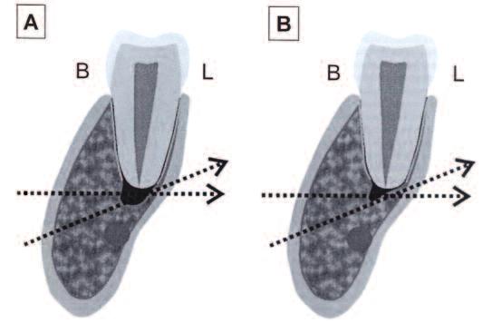2002). 3a 3b Figures 3a and 3b: Pre- and post-operative periapical radiographs with slightly different vertical angulation of the lower left first bicuspid taken on the same day.