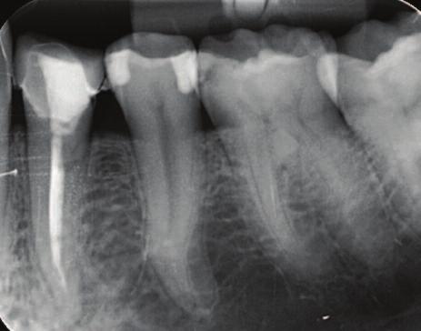 apices to record the apical tissues The X-ray tubehead should be positioned so the beam meets the tooth and the image receptor at right angles in both the vertical and horizontal planes The