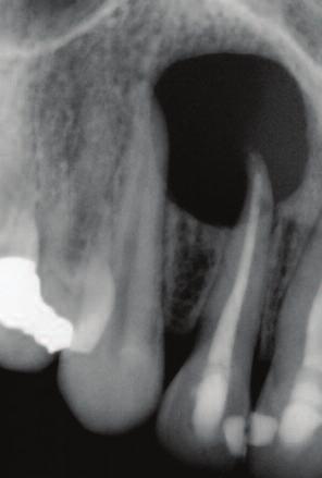 Palatal torus and exostosis Shape of the mandible Depth of the floor of the mouth Mandibular torus Gag reflex Length of the roots.
