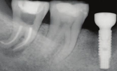 6a Figure 6a: Post-operative radiograph of root canal treatment of lower third molar. Note that the distal extent of the periradicular lesion has not been captured on the radiograph.