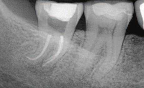 7a Figure 7a: Diagnostic files in the palatal and distobuccal canals showing root divergence in the case shown in Figures 7b and 7c.