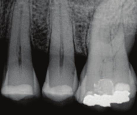 The required diagnostic information for endodontic treatment usually requires an image of only one tooth and can often be obtained from a size one sensor, particularly at the back of the mouth,