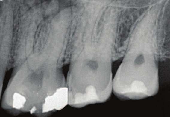 8a 8b Figure 8a: Parallel view of upper first molar buccal roots clearly showing endodontic lesion.