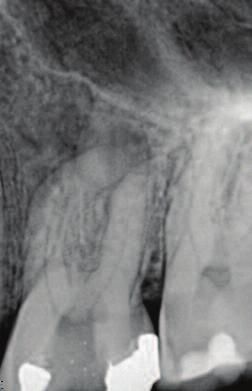 9a 9b Figure 9a: Preoperative radiograph taken with a size two sensor in the horizontal orientation.