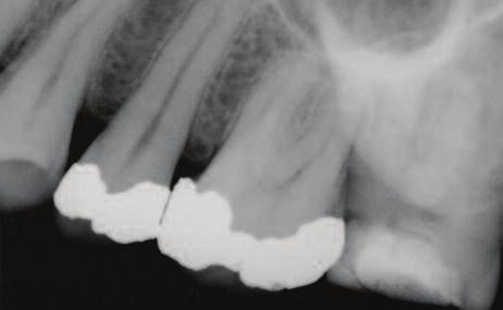 10a 10b Figure 10a: Upper second molar preoperative using a size two sensor. Figure 10b: Upper second molar post-operative radiograph using a size one sensor.