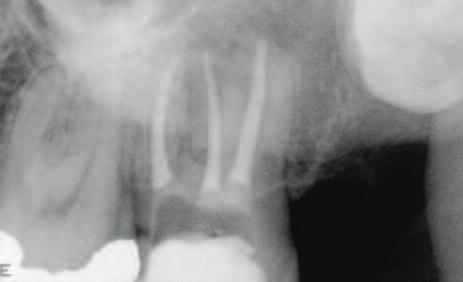 Figure 11b: Actual length of 21mm of the same tooth using a size one sensor (coinciding with the digital length estimation). 12a 12b Figure 12a: Preoperative radiograph of the lower first molar.
