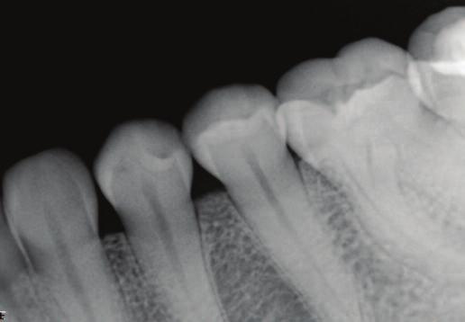13a 13b Figure 13a: Periapical radiograph attempting to X-ray lower second molar using a size two sensor in horizontal orientation.