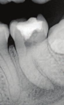 14a 14b Figure 14a: Long rooted lower first molar taken with a size two sensor in horizontal orientation.