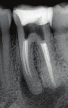 Using a size two sensor in the vertical orientation will allow an extra 10mm and may incorporate a large periapical lesion (Figures 14a and 14b).
