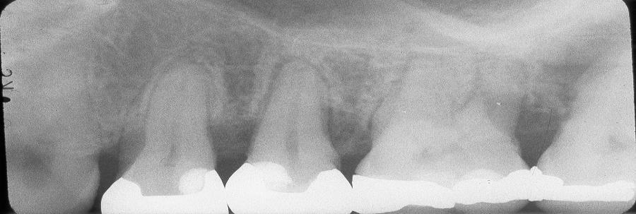through the interproximal space between the cuspid &first bicuspid.