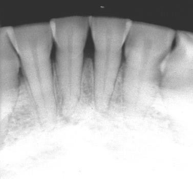 incisors 
