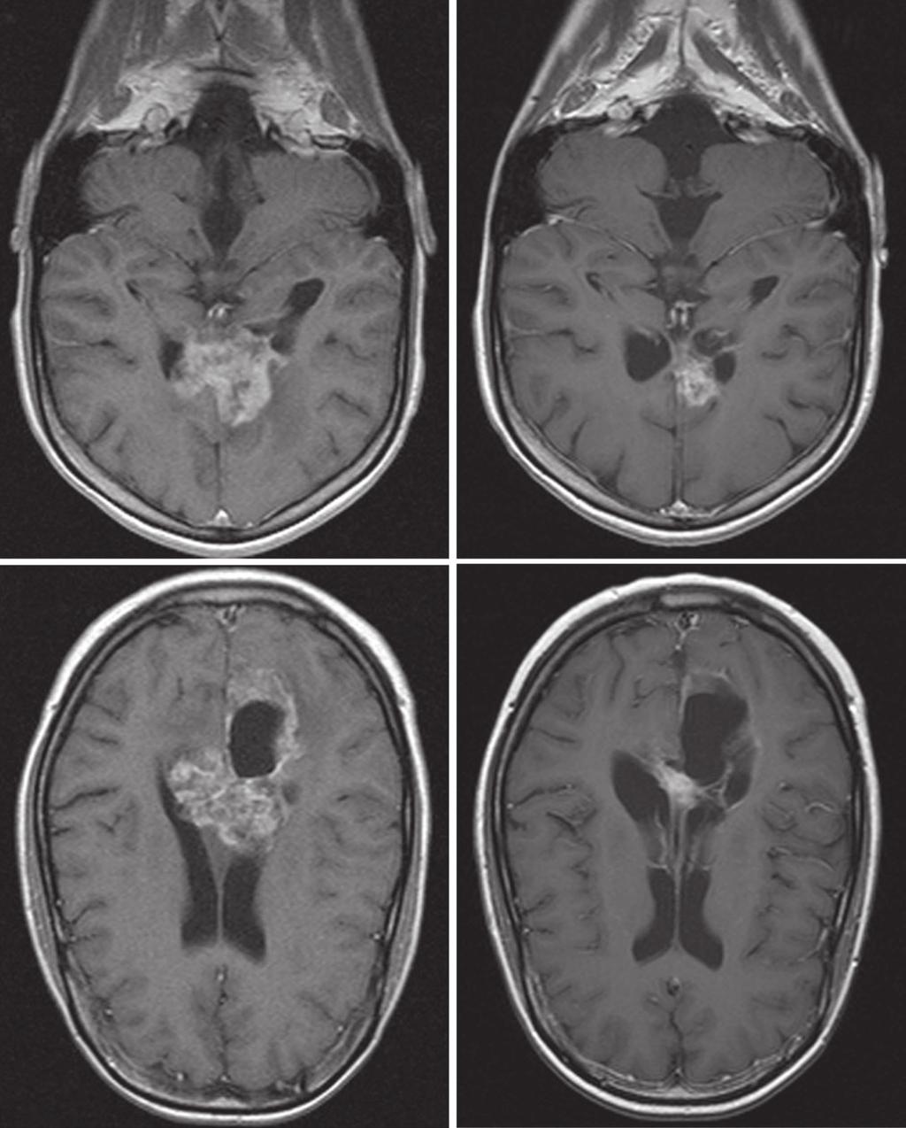 Bevacizumab and Irinotecan for Glioblastoma Multiforme A B C D Fig 3. Baseline and post-treatment magnetic resonance imaging of patients treated with bevacizumab and irinotecan.