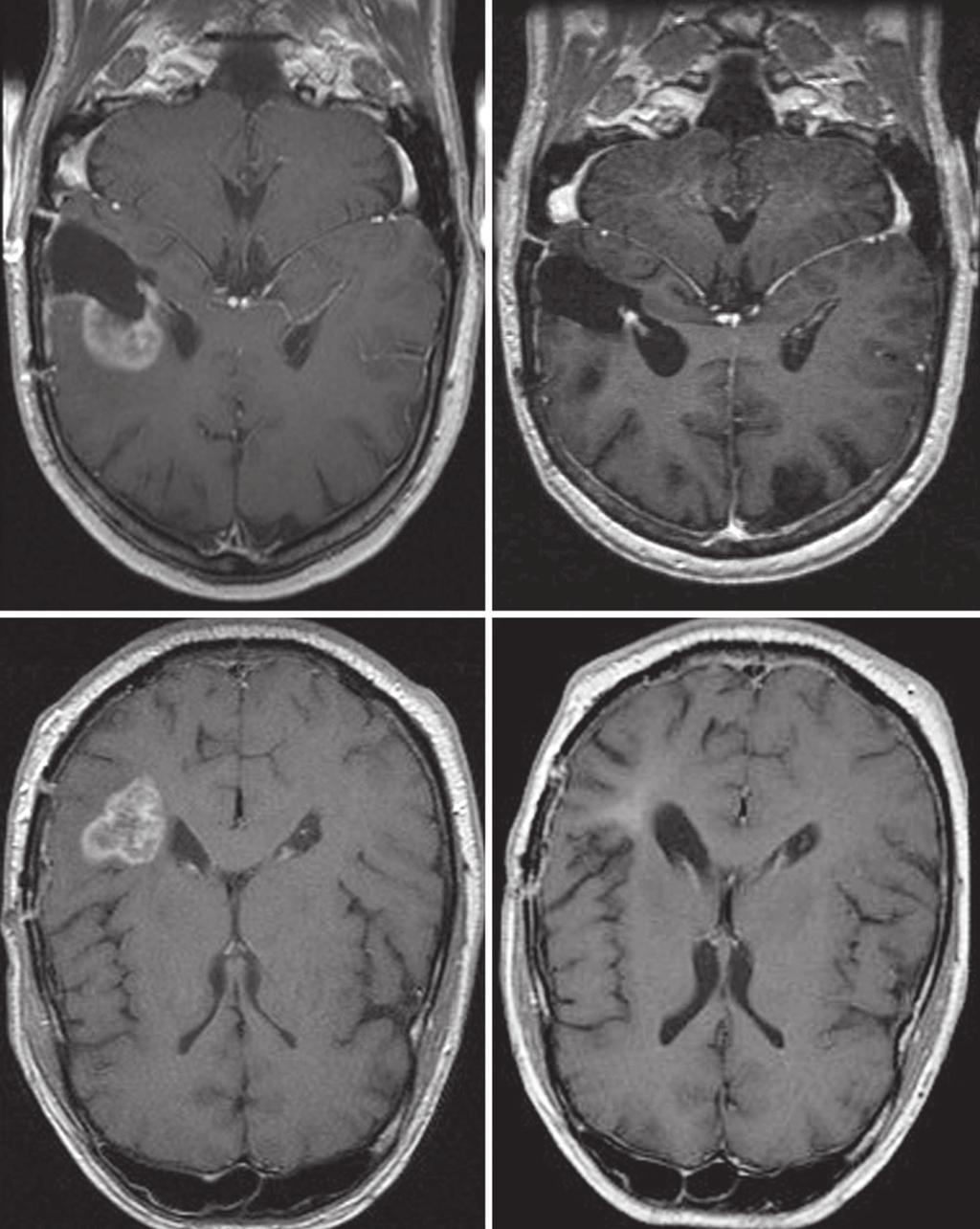 Vredenburgh et al A B C D Fig 4. Baseline and post-treatment magnetic resonance imaging of a second patient treated with bevacizumab and irinotecan.