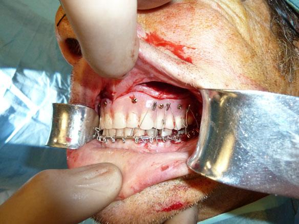 Closed reduction may be appropriate in this case. Historically, wiring the patient into a bimaxillary or Gunning splint was used.