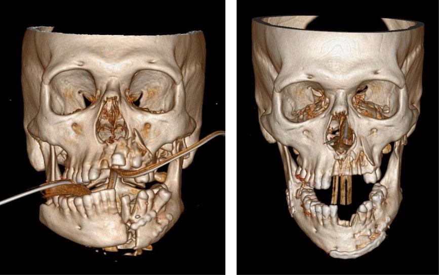 Facial fractures Fig. 9 (a and b) A badly displaced comminuted mandible (with previous fracture and unremovable hardware) repaired with a load bearing rigid plate. Fig. 10 Example of mandibular condyle fractures having undergone open reduction and internal fixation.