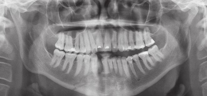 MAXILLA Proposed at the start of the 1900s, the Le Fort classification (I III) is still the most commonly used in describing maxillary fractures The Le Fort I is a horizontal fracture above the tooth