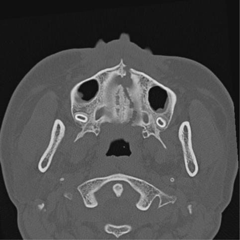 Facial fractures Fig. 15 3D reconstruction CT scan of a split palate, also seen on the axial CT scan views. Fig. 16 The patient's trauma model (bottom model) is sectioned and waxed into an ideal arch form and occlusion (top model), with a splint made and wired into the patient.