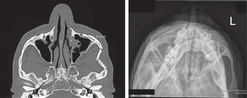 N Vujcich and D Gebauer Fig. 17 A fractured left zygomatic arch on axial CT. A CT scan 2 years later after the original Gillies lift, after another assault. (c) Fig.