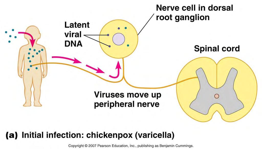 Chicken Pox & Shingles Chicken pox is caused by Herpesvirus varicellazoster (HHV-3): due to symptoms of initial