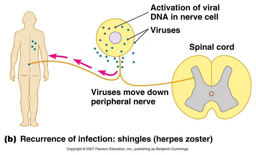 Shingles is due to the activation of