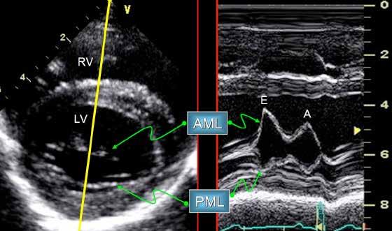 M-mode mitral valve level Obtained from the right-sided short axis or long axis outflow tract view Evaluate mitral valve motion throughout the cardiac