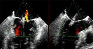 expectancy, severe left ventricular dysfunction (EF<15%), and anatomical features other than optimal should be considered for MitraClip only in exceptional cases.