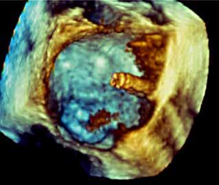 D: Evaluation of final result with formation of a double orifice mitral valve.