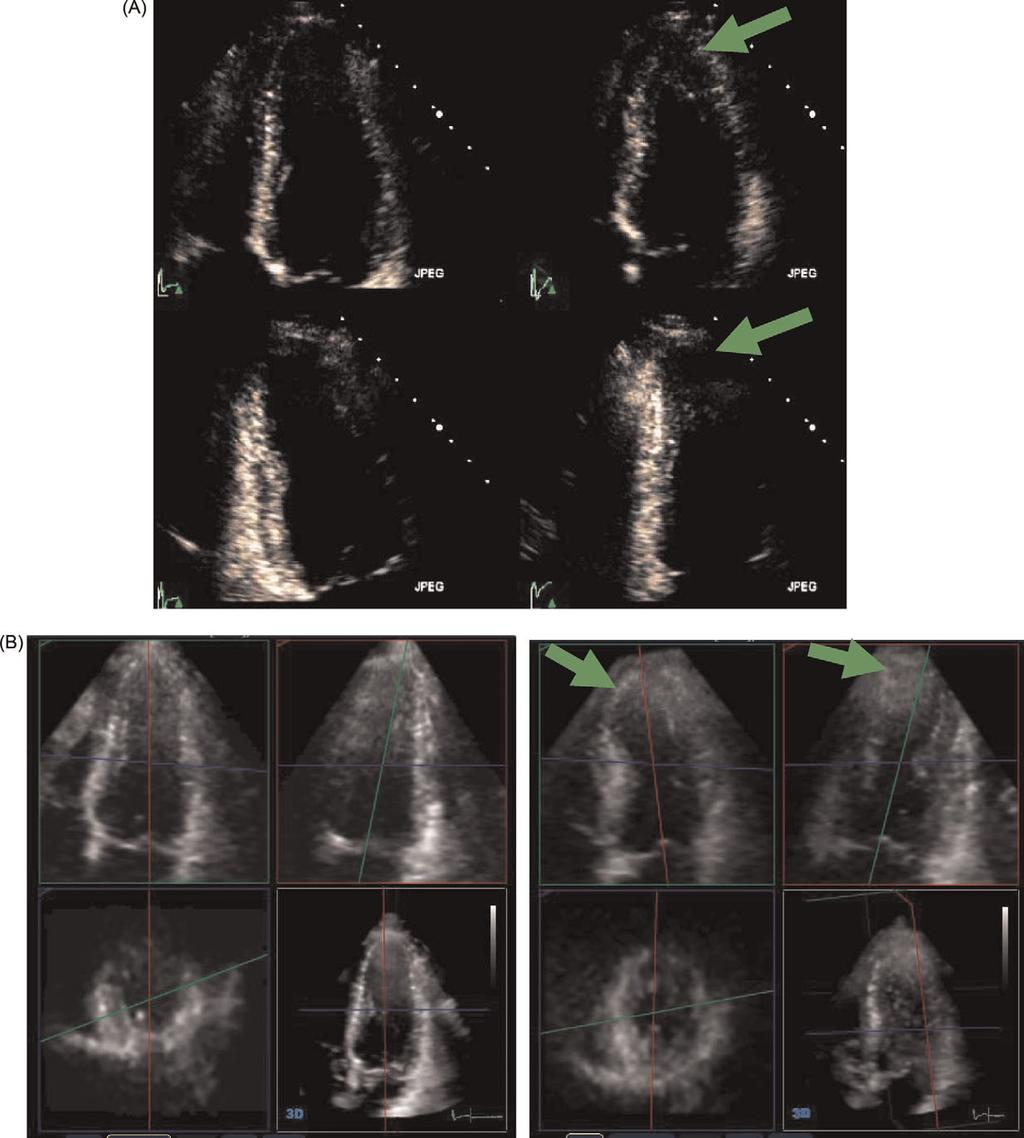 376 C. Jenkins et al. Figure 3 (A) Stress echocardiogram 2DE apical four chamber (top panels) and two chamber (bottom panels) views with rest (left panels) and stress (right panels) images.