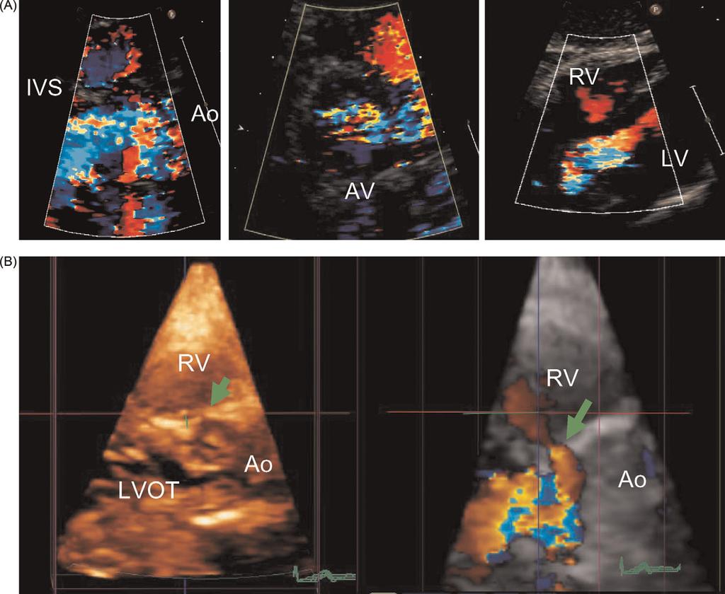Interactive course for 3D echo 377 Figure 4 (A) Colour 2DE images from a zoomed parasternal long axis view (left panel), zoomed parasternal short axis view of the aortic valve and a subcostal four