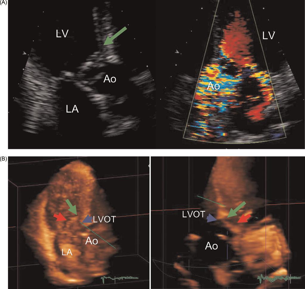 378 C. Jenkins et al. Figure 5 (A) Grey scale and colour 2DE images from a zoomed apical long axis views (left panel), zoomed apical five chamber colour view of the aortic valve (right panel).