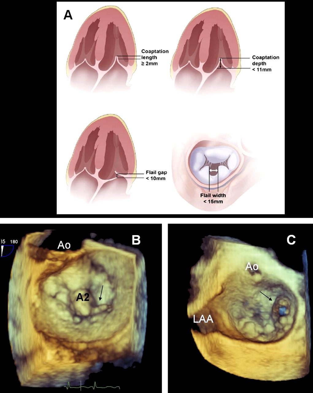 Characterisation of mitral valve lesion before transcatheter edge-to-edge mitral valve repair.