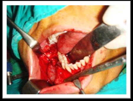 After achieving hemostasis, maxillomandibular fixation was carried out to secure segments of mandibular bone and to prevent trauma to temporomandibular.