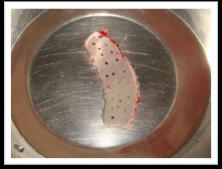 Small perforations were made in this nonvacularized bone graft to ensure proper vascularization (Figure 8).