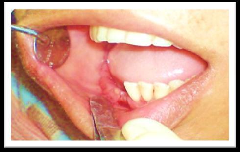 The surgical site was closed with the help of resorbable and nonresorbable sutures. Figure 8.
