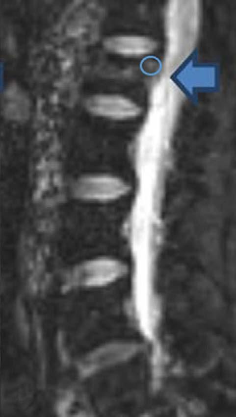 Patients in the neoplastic fracture group had a medical history of extra-skeletal malignancy; vertebral compression fracture either with mass replacing the bone marrow, mass involving the posterior